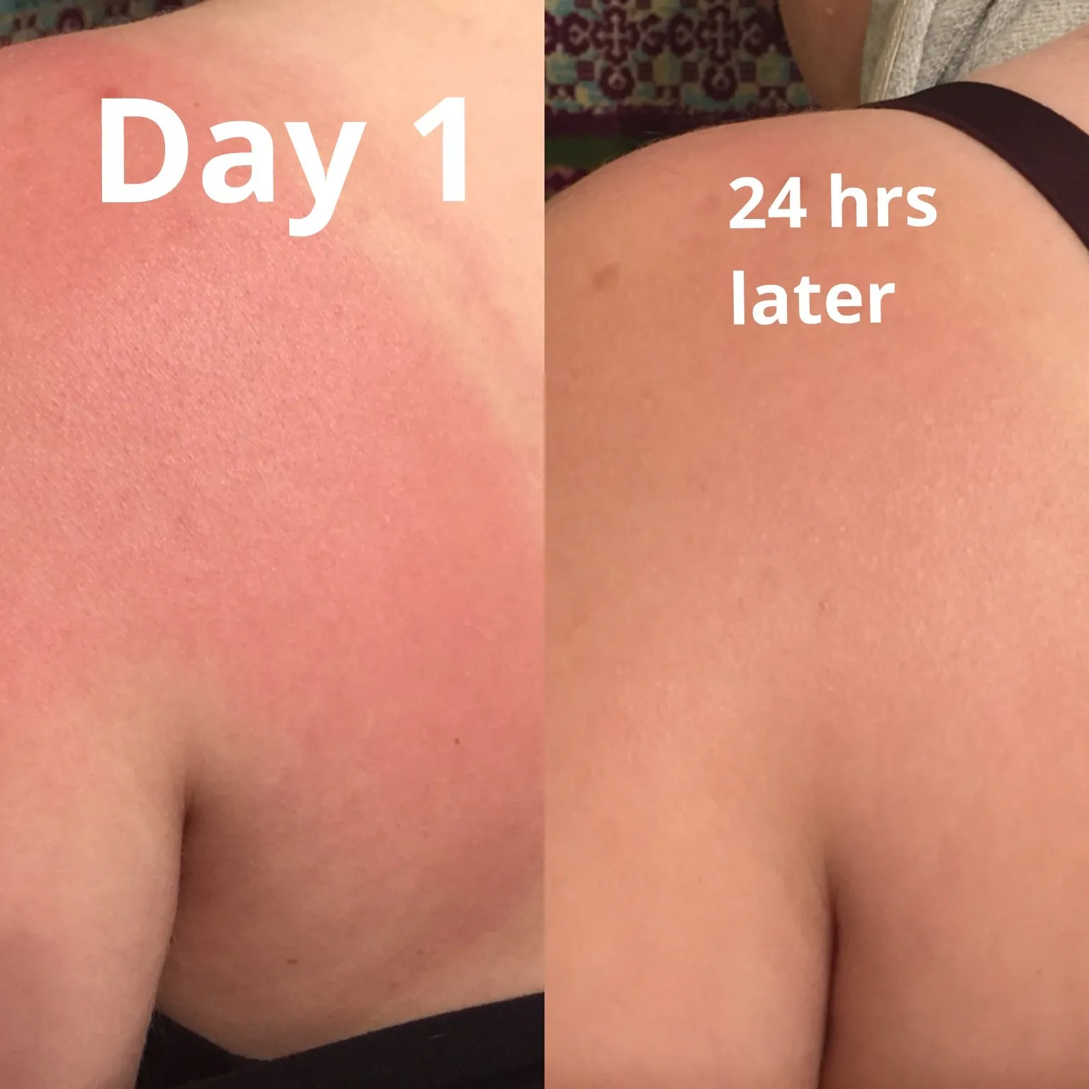 Sunburn Relief Spray- For Calming Skin, Providing Relief & Healing From a Sunburn